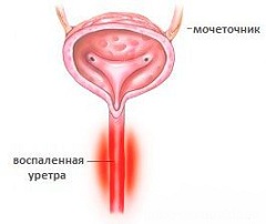 Уретрит воспаление мочеиспускательного канала (уретры)